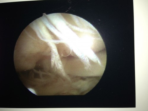 I think that this is the tendon that he got cinched back on.