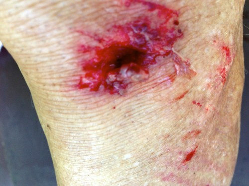 My knee after the race.  I probably should have put a couple stiches in, but didn't have any with me and didn't feel much like the whole hospital ordeal.  I wonder what it looks like today, under the bandage?