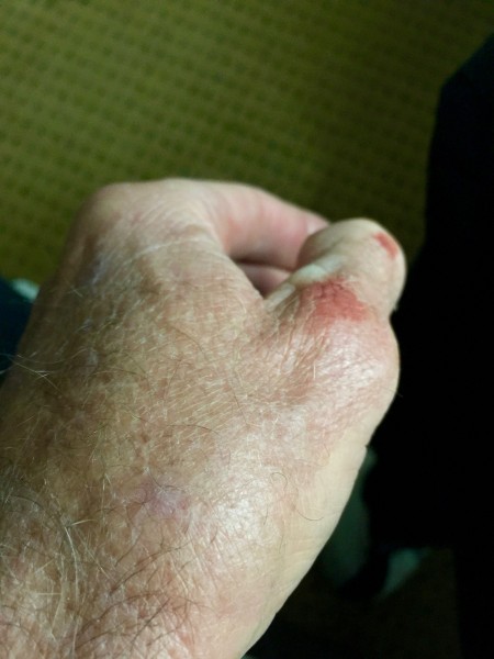 It hard to see, but this thumb is super swollen. 