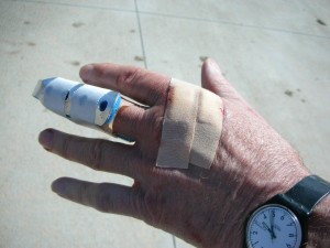 Dennis Kruse's dog bite hand after hospital visit.