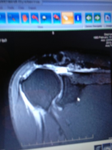 This is a MRI of my shoulder.  I have two completely torn tendons, one retracted 6.7 cm and the other 3.9 cm.  Not a good thing.