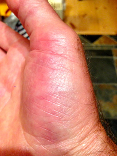 Swollen thumb.
