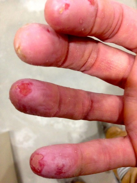 The picture was from yesterday.  Today my fingers look much worse.