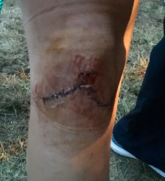 This is Leah Kleager's knee after her becoming up close and personal with the Berryman rocks. She had something like 40 stitches. She was in super good spirits and was bummed she didn't finish. Next year.