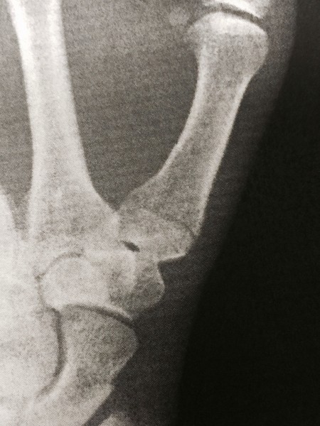 Photo of my x-ray. The dark line at the base of the thumb is the fracture.