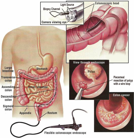 colonoscopy-1